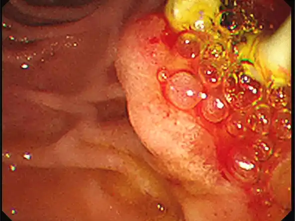 Procedimiento endoscópico